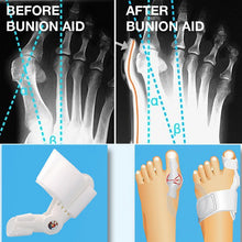 Feet Care Hallux Valgus Fixed Thumb Orthopedic Daily And Night Using Toe Bone Pedicure Bunion Aid Care